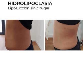 Hidrolipoclasia antes y después - 854753
