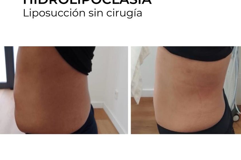Hidrolipoclasia antes y después - 854753