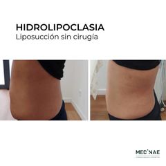 Hidrolipoclasia - Medinae