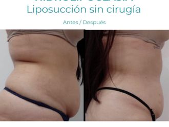 Hidrolipoclasia antes y después - 854754