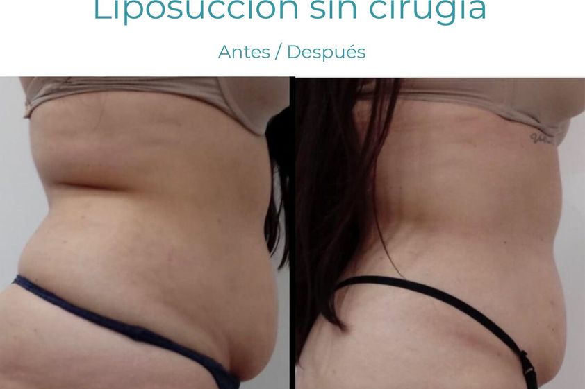 Hidrolipoclasia antes y después - 854754