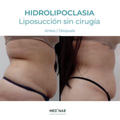 Hidrolipoclasia - Medinae