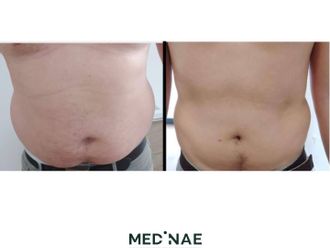 Hidrolipoclasia antes y después - 854755