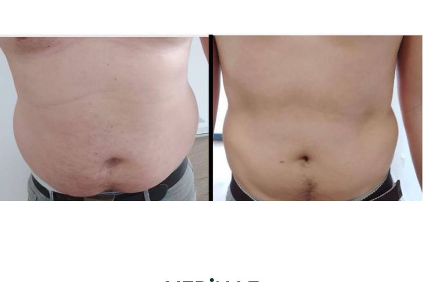 Hidrolipoclasia antes y después - 854755