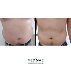 Hidrolipoclasia - Medinae