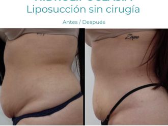 Hidrolipoclasia antes y después - 854761