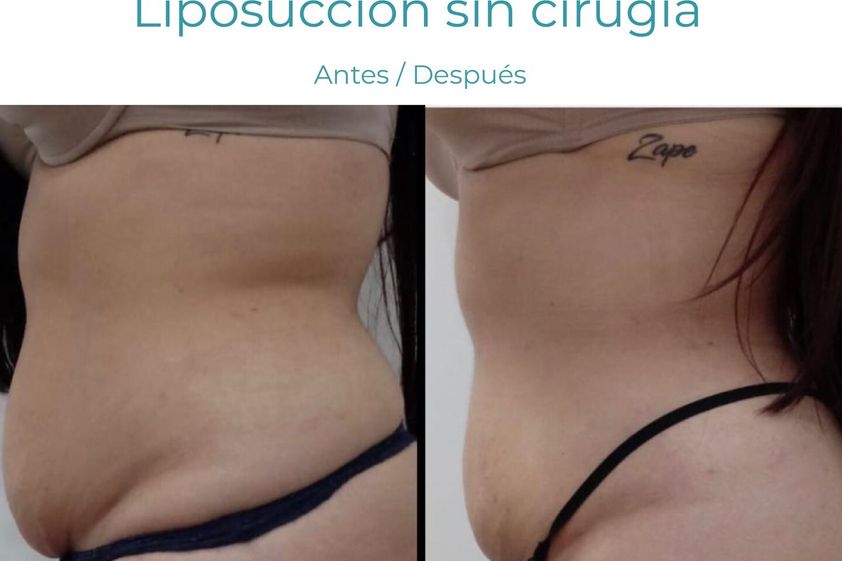 Hidrolipoclasia antes y después - 854761