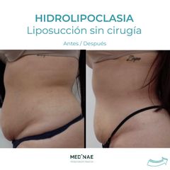 Hidrolipoclasia - Medinae