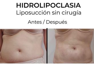 Hidrolipoclasia antes y después - 854762