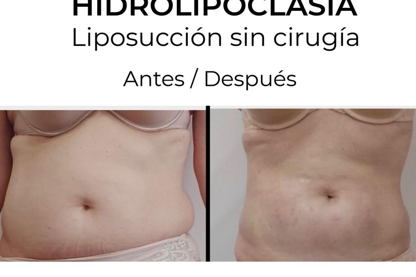 Hidrolipoclasia antes y después - 854762