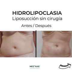 Hidrolipoclasia - Medinae