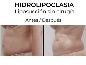 Hidrolipoclasia - 854763