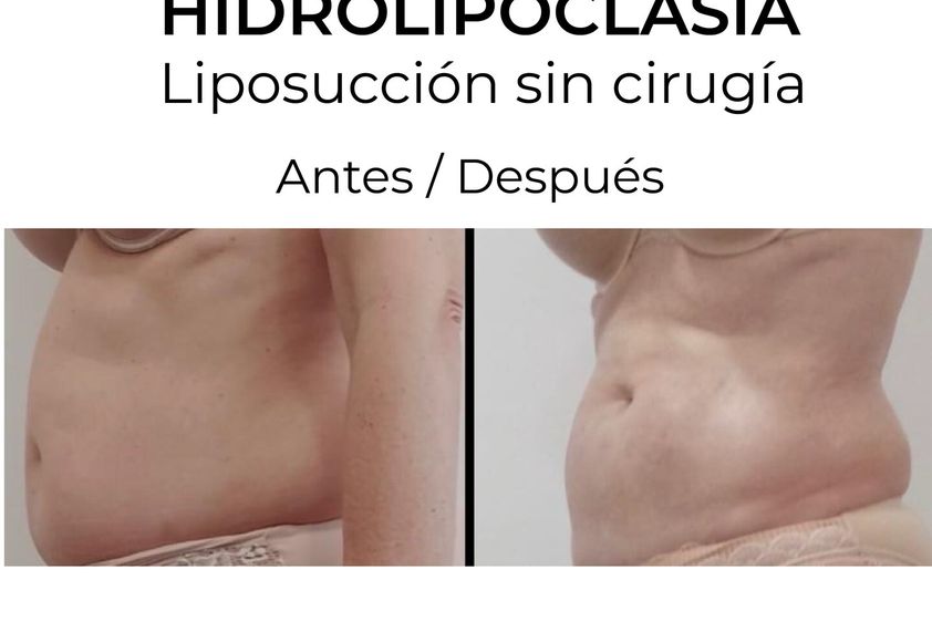 Hidrolipoclasia antes y después - 854763