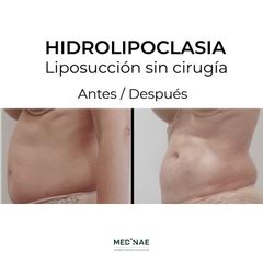 Hidrolipoclasia - Medinae