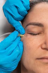 Carboxiterapia - Dra. Olivia Vega Oomen