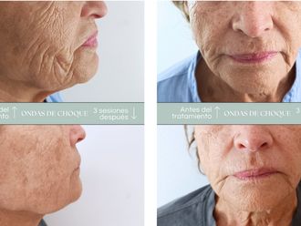 Rejuvenecimiento facial antes y después - 877216