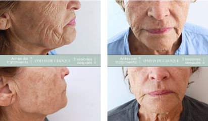 Dra. Olivia Vega Oomen - Rejuvenecimiento facial