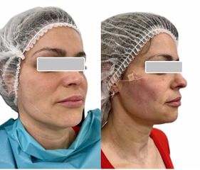 Skn clinic by Leo - Rejuvenecimiento facial