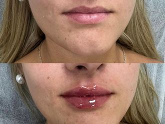 Aumento labios antes y después - 874768