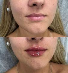 Skn clinic by Leo - Aumento de labios