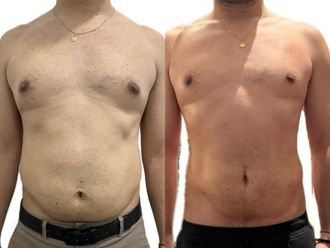 Criolipólisis antes y después - 874772