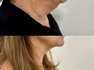 Rejuvenecimiento facial antes y después - 874773