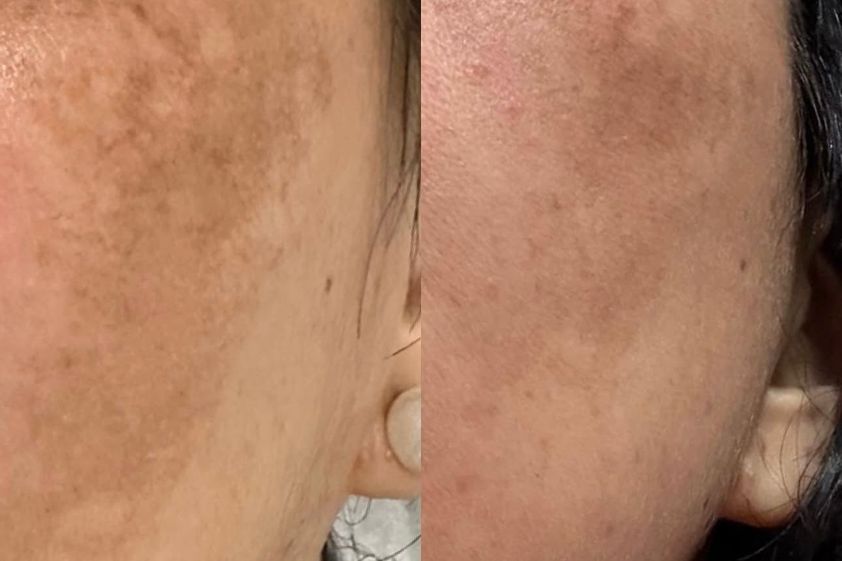 Peeling antes y después - 874775