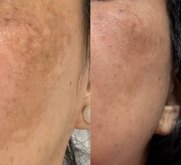 Skn clinic by Leo -PEELING Y VITAMINA C