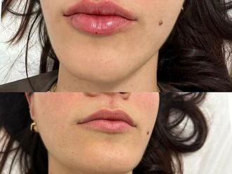 Aumento labios antes y después - 874776