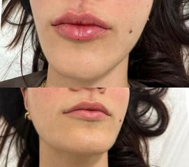 Skn clinic by Leo - Aumento de labios