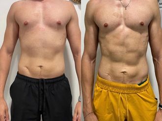 Lipoláser antes y después - 874777