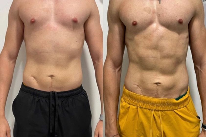 Lipoláser antes y después - 874777