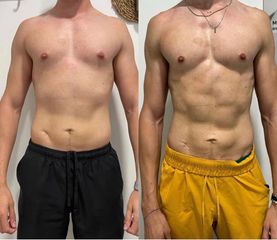 Skn clinic by Leo - LASER LIPOLISIS