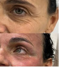 Skn clinic by Leo - LASER CO2
