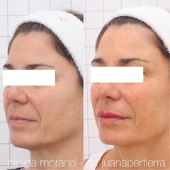Rellenos faciales - Clinica Doctor Morano