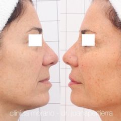 Rellenos faciales - Clinica Doctor Morano