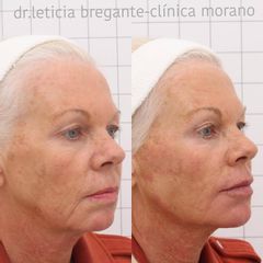 Ácido hialurónico - Clinica Doctor Morano