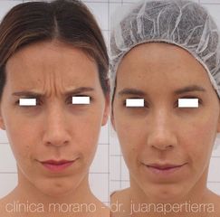 Eliminación arrugas - Clinica Doctor Morano