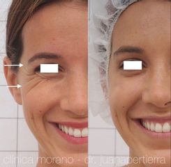 Eliminación de arrugas - Clinica Doctor Morano