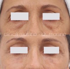 Eliminación de ojeras - Clinica Doctor Morano