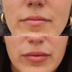 Aumento de labios - Clinica Doctor Morano