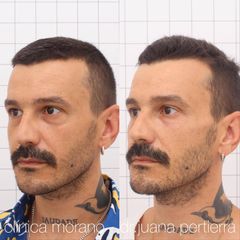Eliminación de ojeras - Clinica Doctor Morano