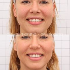 Aumento de labios - Clinica Doctor Morano