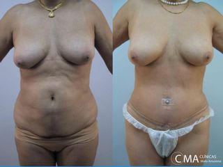 Antes y después Abdominoplastia