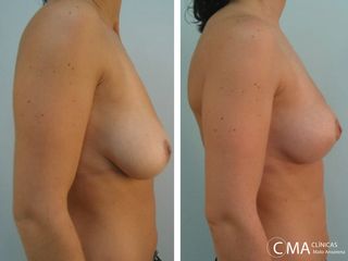 Antes y después Mastopexia 
