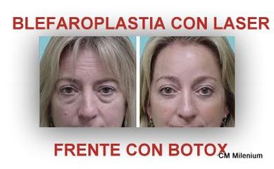 Antes y después Blefarolaser, toxina botulínica en frente