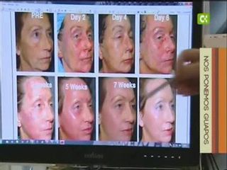 Antes y después Resurfacing tvc