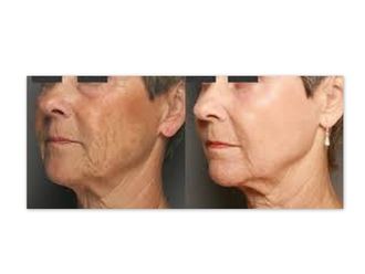 Láser vascular - 418567