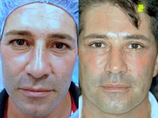 Antes y después Blefaroplastia superior con láser intervención junio 2015