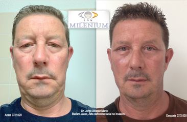 Antes y después Blefaroplastia sin cirugia 